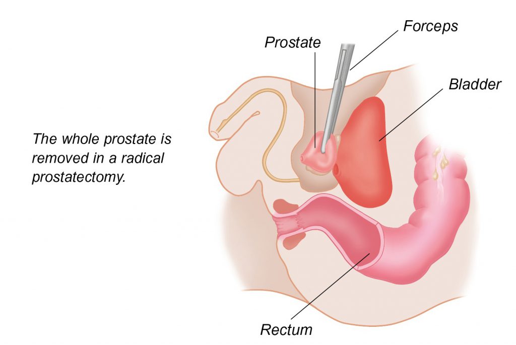 Is prostate cancer curable uk