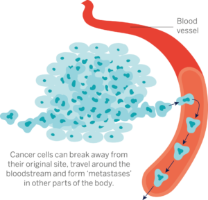 Image of Cancer cells breaking away from their original site and forming metastases. Treating prostate cancer bone metastasis.